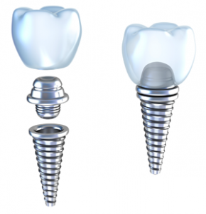 Dental Implants Trophy Club Texas